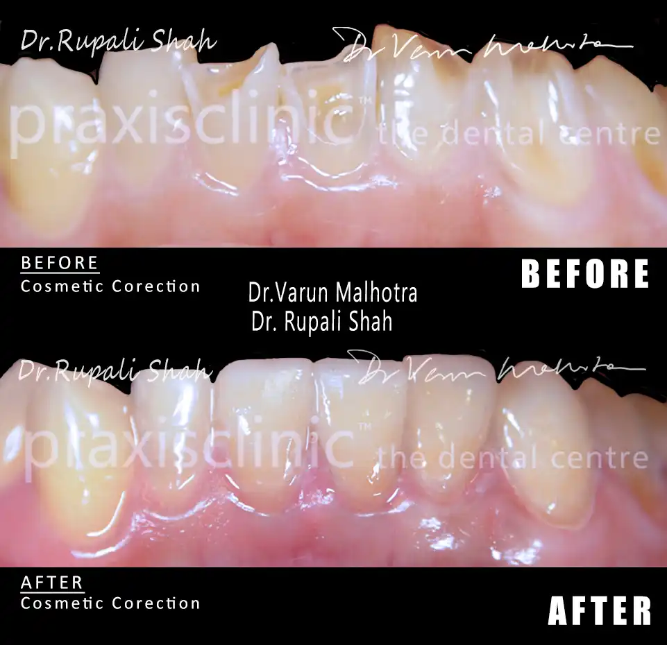 Cracked and chipped tooth repair before and after — cosmetic bonding and porcelain veneers by Dr Varun Malhotra, PRAXIS Dental Mumbai India