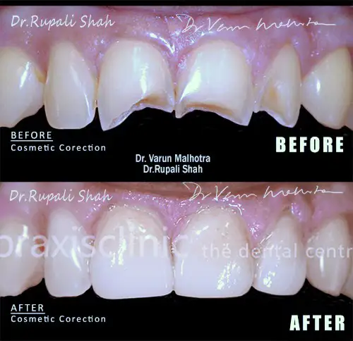 cosmetic dentistry treatment Mumbai India