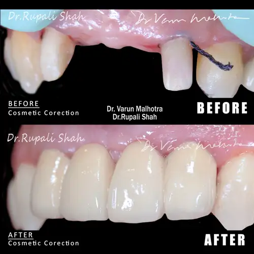 dental crowns bridges cosmetic dentistry Mumbai
