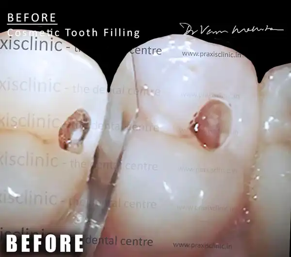 tooth colored fillings cosmetic dentist Mumbai