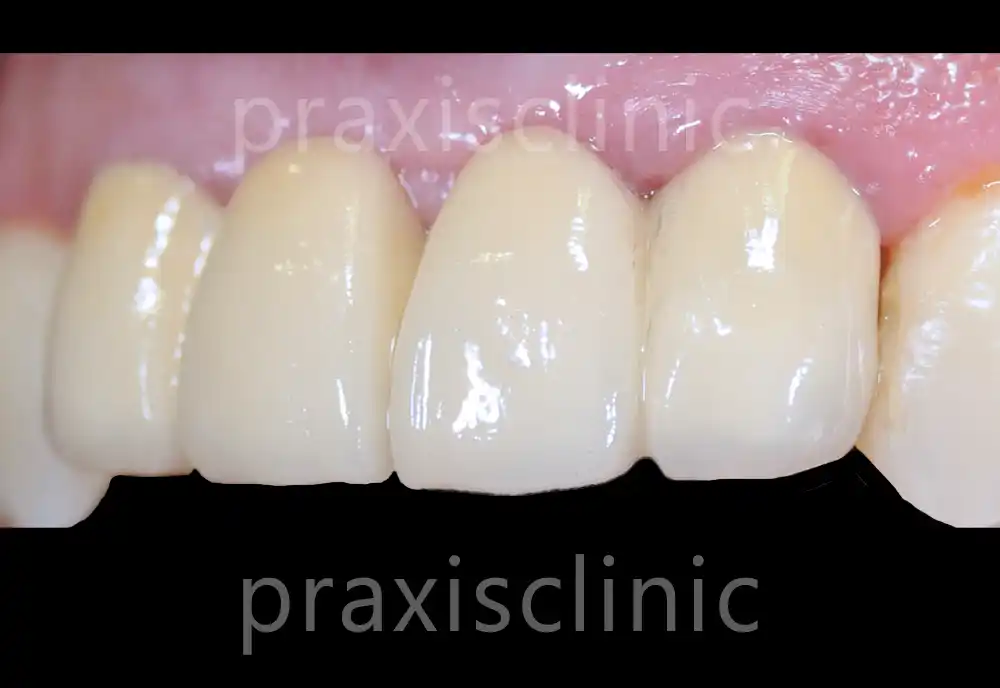 PFM porcelain fused to metal crowns budget option Mumbai