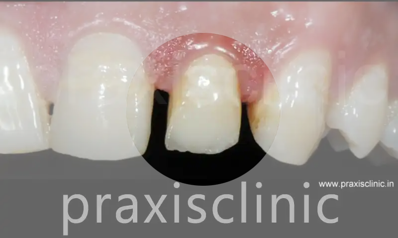 e.max ceramic crowns front teeth Mumbai Andheri PRAXIS Dental