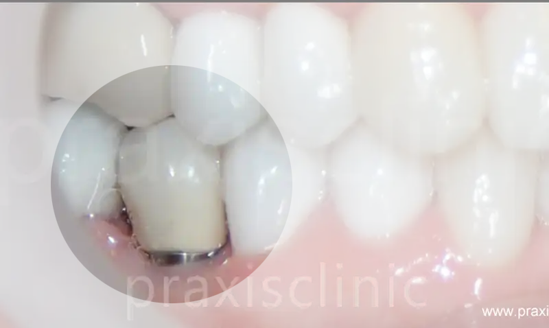 Implant crown single tooth replacement Mumbai PRAXIS Dental