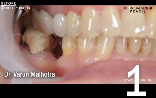 Missing Tooth in the lower jaw of a patient , planned to be replaced with a dental implant at Praxis Dental Clinic, Mumbai, India by Dr Varun Malhotra , Mumbai's Top Dental 
                            Implant surgeon of Mumbai, India 