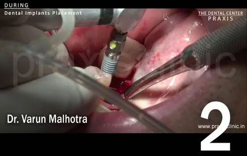 Image of a dental implant being surgically placed at the location of the missing molar tooth in the lower jaw. Dental Implant surgery and images by Dr. Varun Malhotra ( Dental Implant Surgeon ) at PRAXIS, The Dental Center, Mumbai, India.