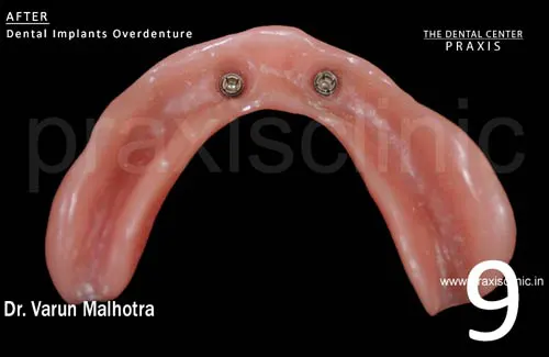 Image of denture of the patient showing specialised attachmnents fitted in their existing
                              denture , which will anchor to the the two dental implants . Dental Implant Surgery by Dr. Varun Malhotra ( Dental Implant Specialist ) at PRAXIS, The Dental Center, Mumbai, India.