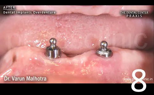 Image of lower jaw of a patient showing specialised attachments on top of dental implants 
                                for a Dental Implant Supported Overdenture. Dental Implant Surgery by Dr. Varun Malhotra ( Dental Implant Specialist ) at PRAXIS, The Dental Center, Mumbai, India.