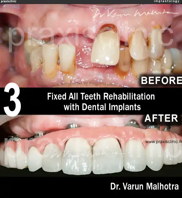 Before and After results of replacing all missing teeth with Dental Implant in Mumbai India