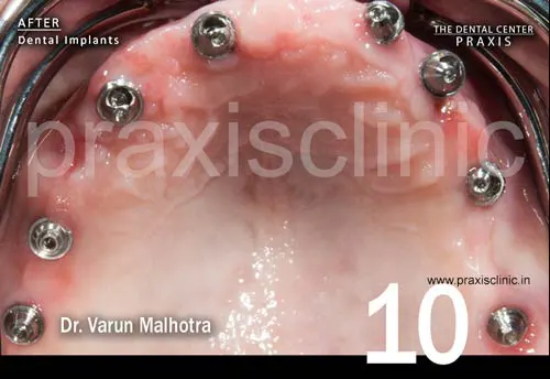 Multiple dental implants surgically  placed in the both jaws of a patient , as part of the planned Full Mouth Rehabilitation to replace all the missing teeth with dental implants at Praxis Dental Clinic by Dr Varun Malhotra, Top Dental 
                        Implant Surgeon of Mumbai India 