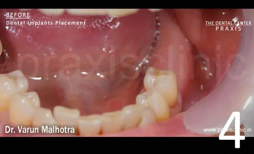 Multiple Missing Teeth in the lower jaw of a patient , planned to be replaced with 2 dental implants at Praxis Dental Clinic, Mumbai, India by Dr Varun Malhotra , Mumbai's Top Dental 
                            Implant surgeon of Mumbai, India 