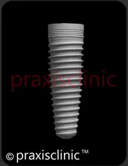 Dental Implants by Dr. Varun Malhotra ( Dental Implant Specialist ), Best Dentist in Mumbai, India