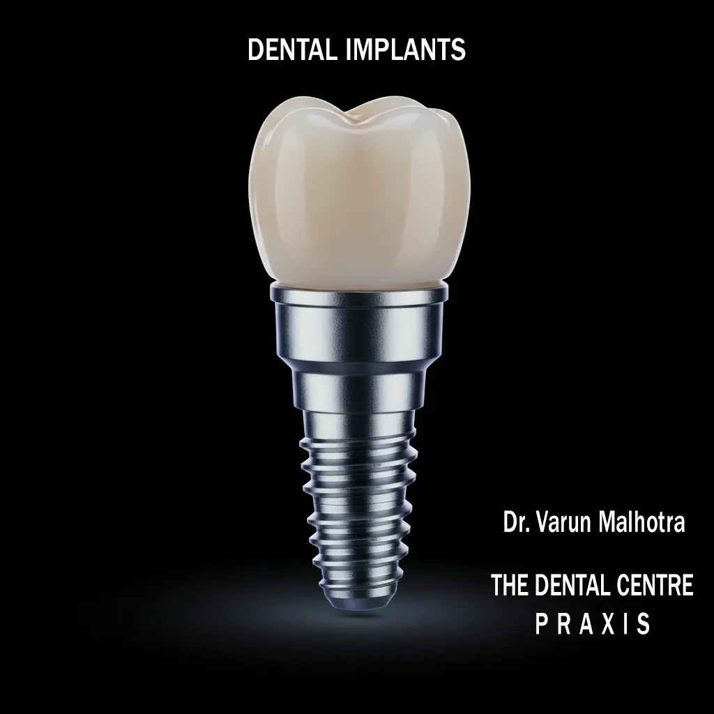 Dental Implants by Dr. Varun Malhotra ( Dental Implant Specialist ), Best Dentist in Mumbai, India