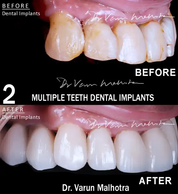 Before and After results of Multiple teeth dental implant in Mumbai India