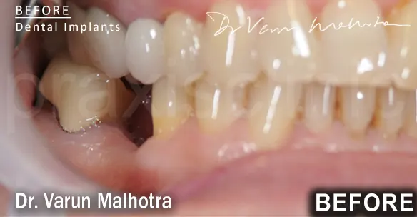 Missing Tooth in the lower jaw of a patient , planned to be replaced with a dental implant at Praxis Dental Clinic, Mumbai, India by Dr Varun Malhotra , Mumbai's Top Dental 
                        Implant surgeon of Mumbai, India 
