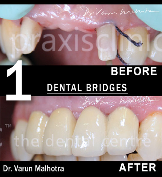 Dental Bridges to Replace Missing Teeth