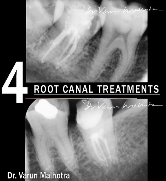 Dental fillings / Tooth Matching Fillings
