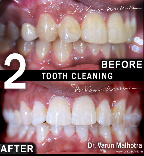 Tooth Cleaning - results after cleaning of teeth