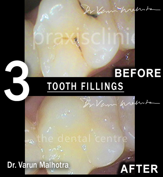 Dental fillings / Tooth Matching Fillings