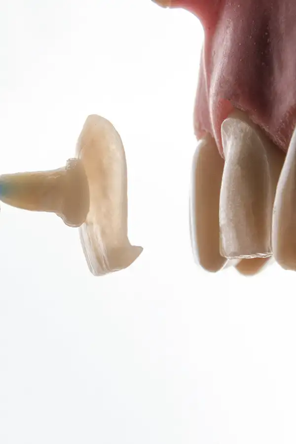 Porcelain veneers smile makeover before and after — best dentist for porcelain veneers near Andheri Vile Parle Mumbai India Dr Varun Malhotra PRAXIS Dental