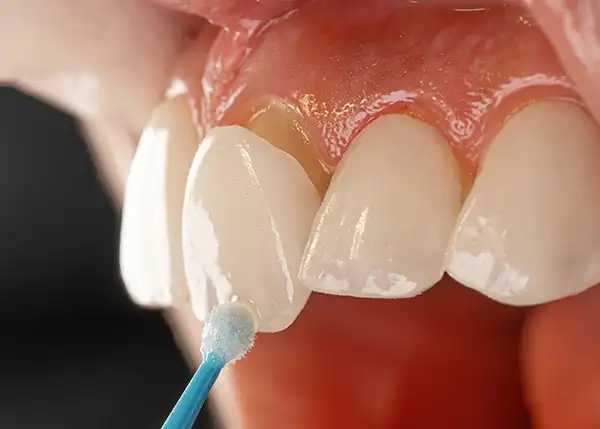Non-prep minimal-prep ultra thin porcelain veneers before and after — PRAXIS Dental Mumbai India