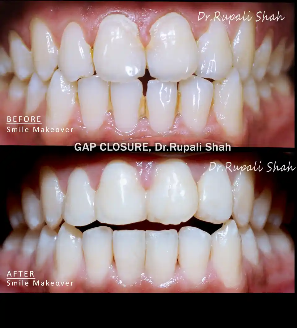 Porcelain veneers gap closure and whitening before and after — best dentist for veneers near Vile Parle Andheri Mumbai PRAXIS Dental