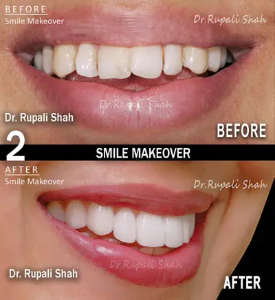 Smile makeover with composite veneers and teeth whitening before and after — PRAXIS Dental Mumbai, top smile makeover dentist India