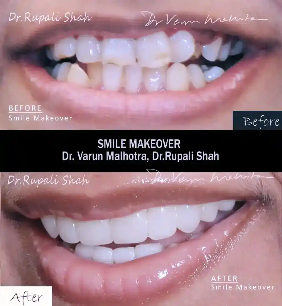 Full porcelain veneer smile makeover 8 teeth before and after — best cosmetic dentist veneers Mumbai PRAXIS Dental