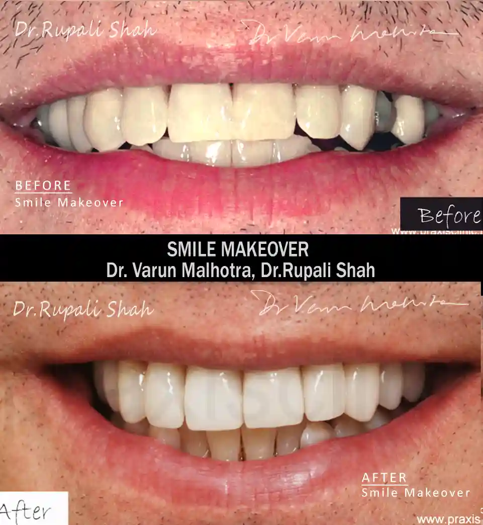 Smile makeover for cracked and broken teeth — ceramic crowns and cosmetic bonding before and after at PRAXIS Dental, best dentist for smile makeover in Mumbai India