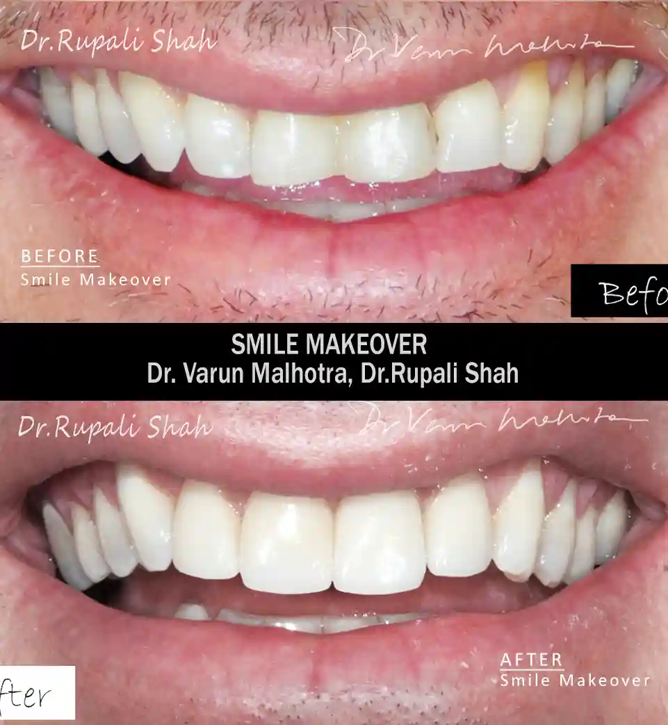 Smile Correction with ceramic veneers as part of smile makeover — before and after result at PRAXIS Dental, best smile makeover dentist Mumbai India