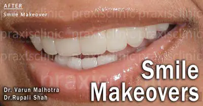 Perfect Smile by Best Cosmetic Dentist in Mumbai Dr. Rupali Shah Malhotra, at The Dental Centre PRAXIS, Mumbai, India
