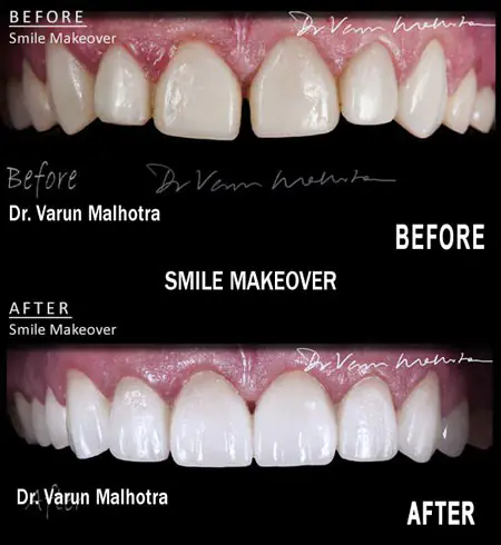Perfect Smile by Dr Varun Malhotra Best Cosmetic Dentist in Mumbai, India at The Dental Center PRAXIS