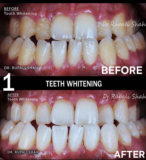Professional Teeth Whitening at The Dental Center PRAXIS for treatiing Stained Teeth effectively and best results.