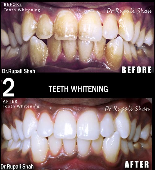 Heavily stained teeth treated with Professional Teeth Whitening at The Dental Center PRAXIS displaying effective whitening of the teeth after treatment.