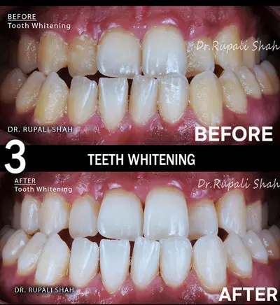 Teeth Whitening by Best Cosmetic Dentist in Mumbai Dr. Rupali Shah Malhotra ( Cosmetic Dentist ), at The Dental Centre PRAXIS, Mumbai, India